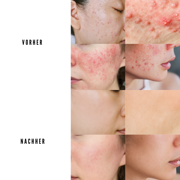 PureSkin Pro